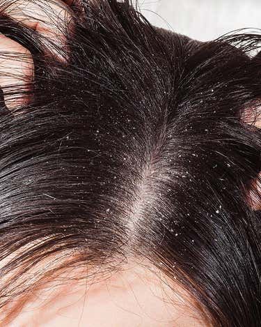 Dandruff & Itchy Scalp
